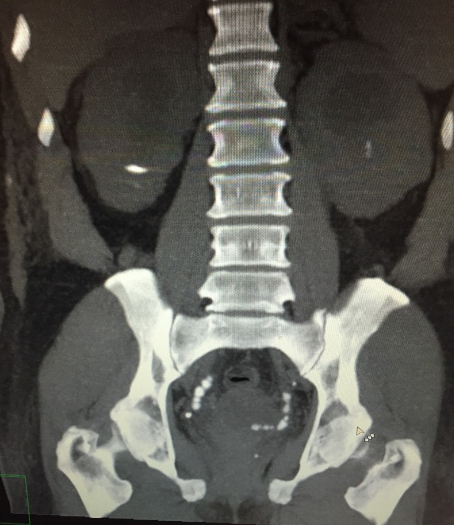 Ureteral stones